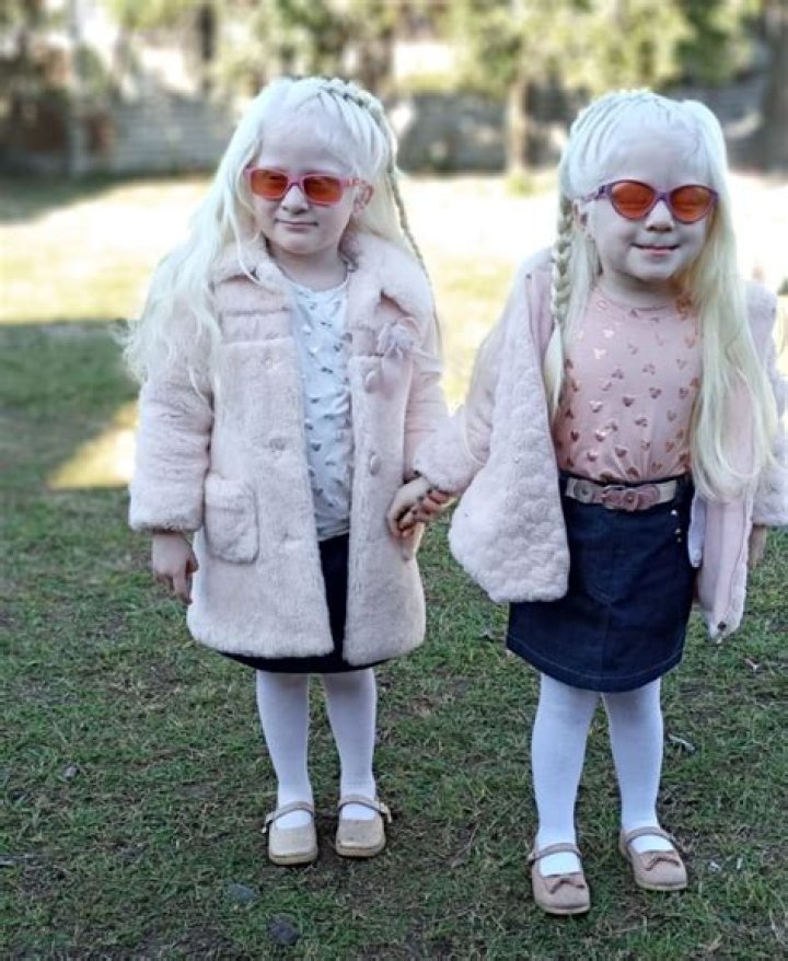 Parents of albino twins tired of beinf accused of having affairs