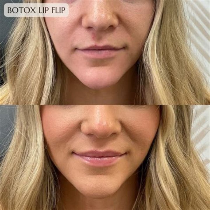 Woman almost lost her lip after fillers at Botox party caused them to double in size