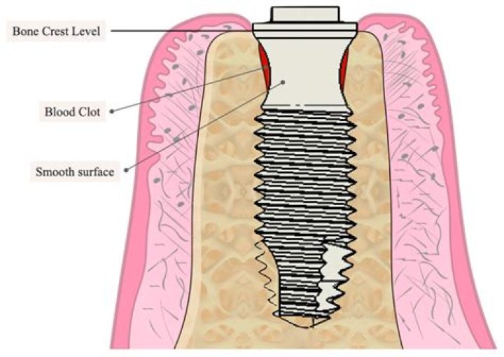 28-year-old woman had eyelash transplant using hair from her crotch in quest to look like a cartoon