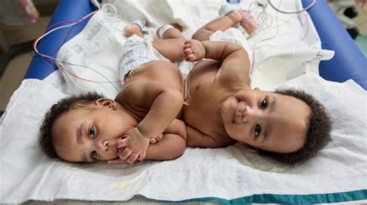 Conjoined Twins Separated in Risky Surgery 13 Years Ago Are Teenagers Now