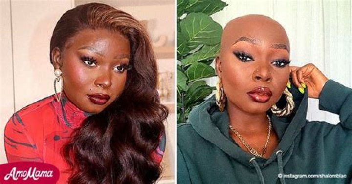 YouTube Star Shalom Blac, 25, Recalls Getting Burned as a Child in Nigeria