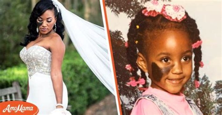 Bride Refuses to Cover Her Birthmark, People Wonder Why She's Not Ashamed of It