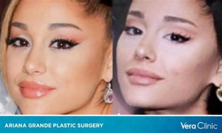 Has Ariana Grande Had Plastic Surgery? Experts Differed in Their Opinions