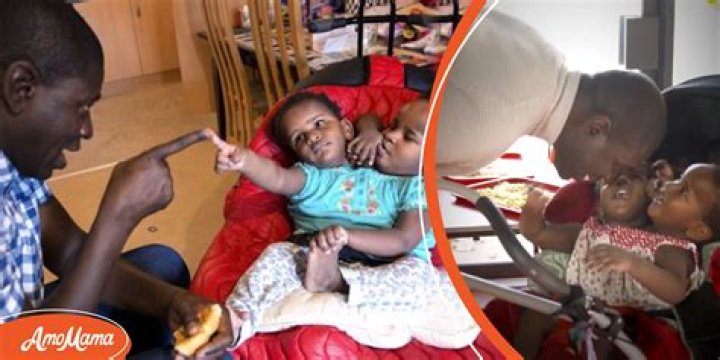 Single Dad of Conjoined Twins Has to Choose Whether to Save One Girl with Separation Surgery or Risk Losing Both