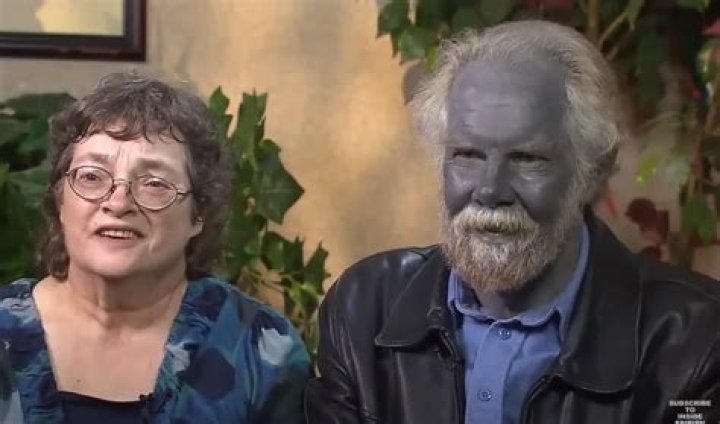 Real-Life ‘Papa Smurf’: Man Turned Blue after Being Born Fair-Skinned with Reddish-Blond Hair