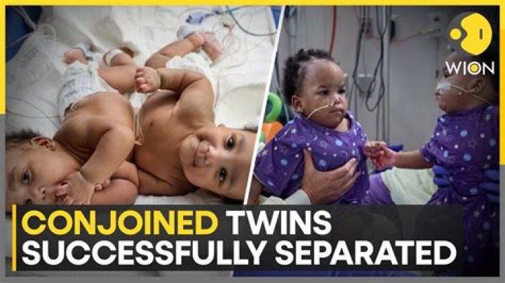 Conjoined twins successfully separated 12 years ago have matured into unique individuals